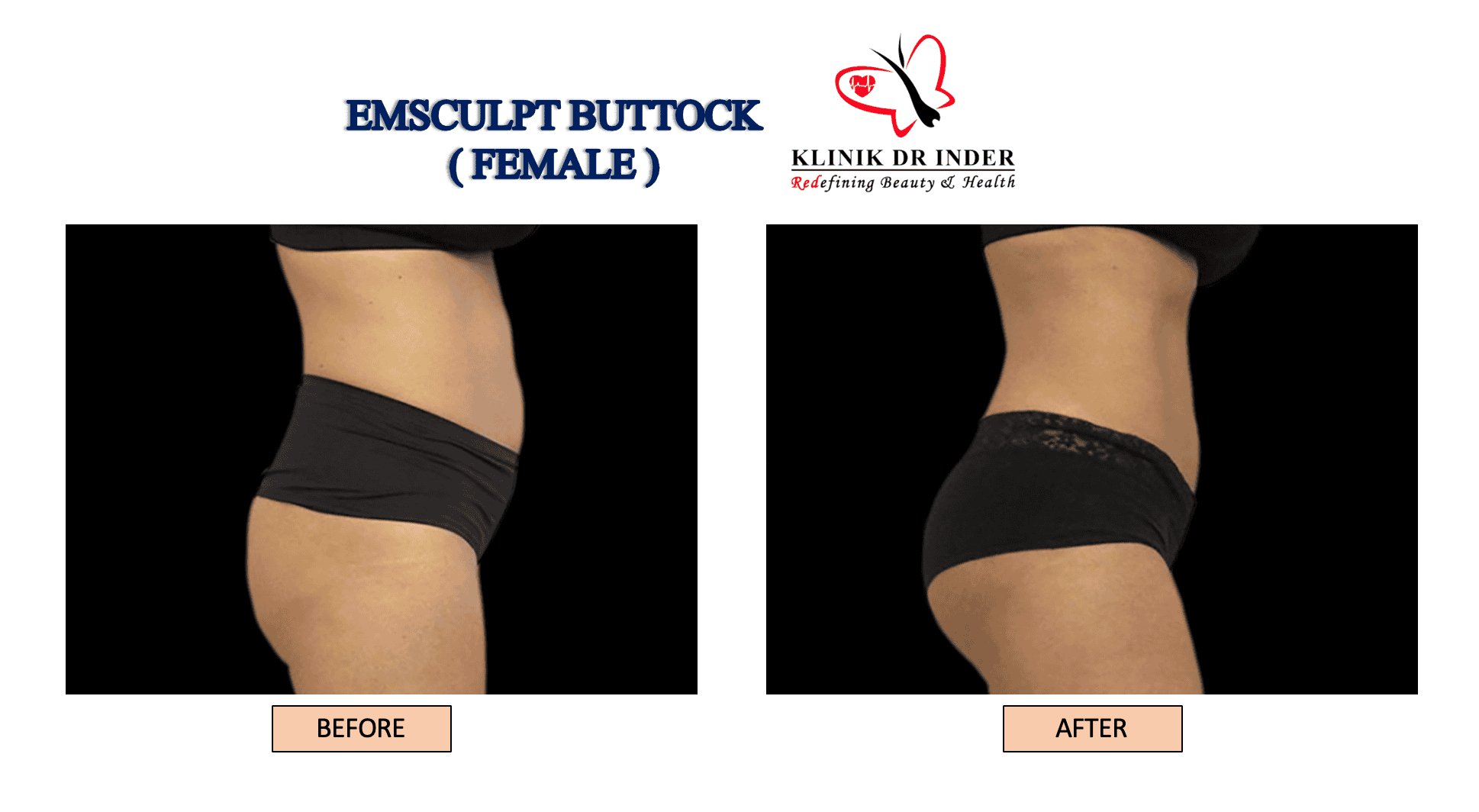 Emsculpt Malaysia Body Contouring Lose fat Built Muscle