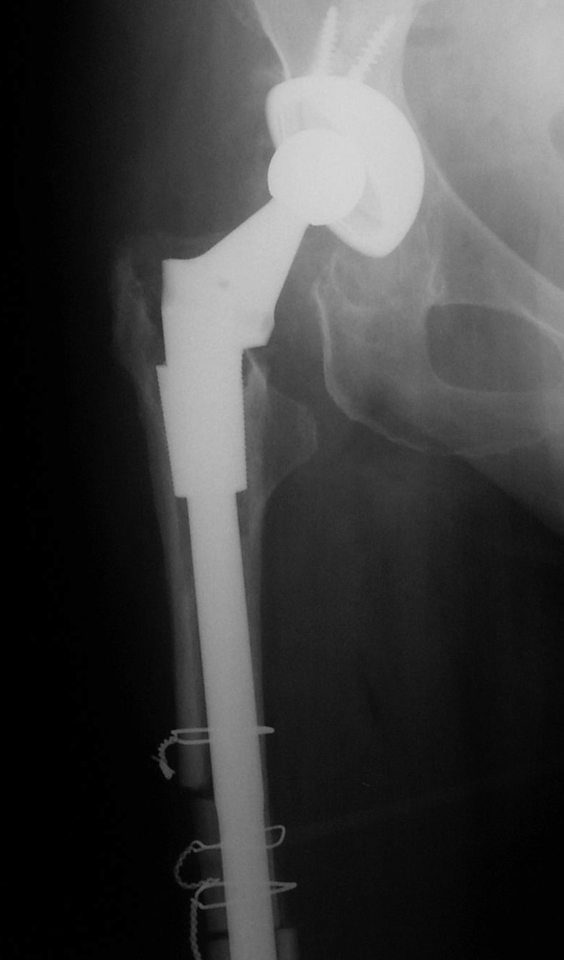 Hip arthroscopy Knee, Hip and Shoulder(04)