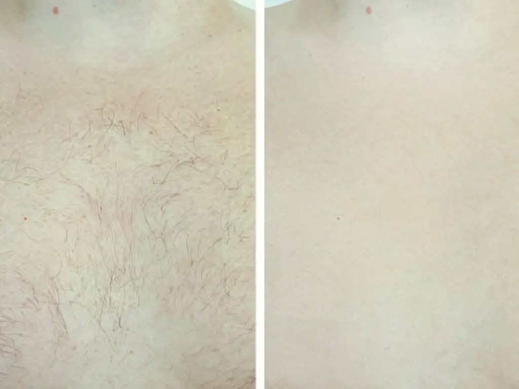 What Are the Different Types of Laser Hair Removal? konmison