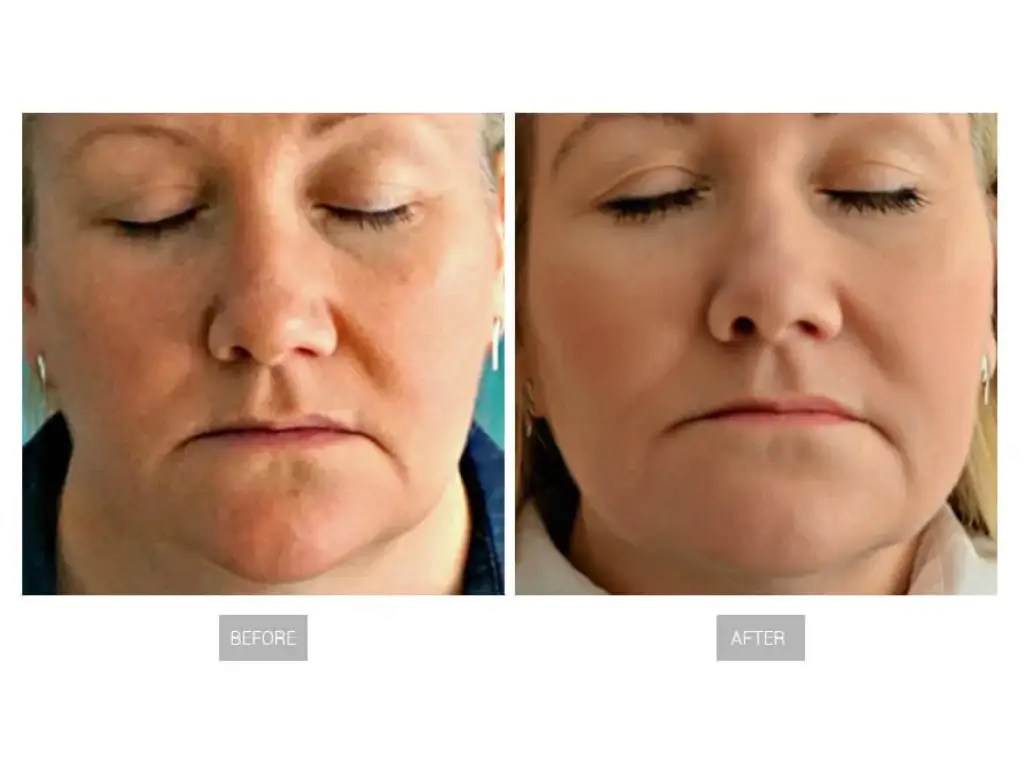 Radio Frequency vs Red Light Therapy The Ultimate FaceOff konmison