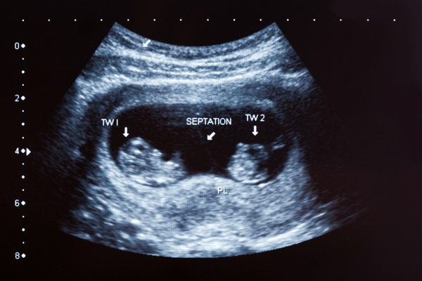 Week 8 Pregnancy Symptoms, Baby Belly Bump, & Twins Kopa Birth®