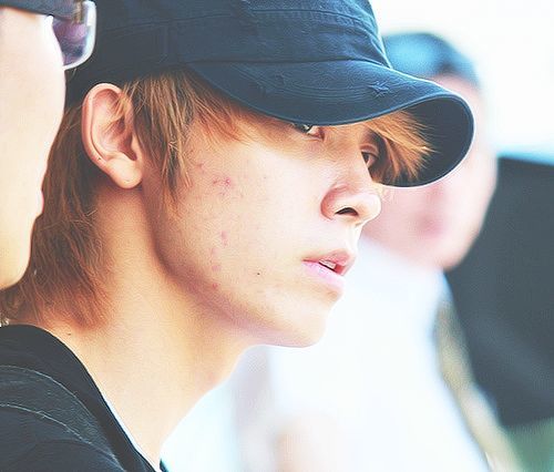 9 Idols Who Suffered From Severe Acne