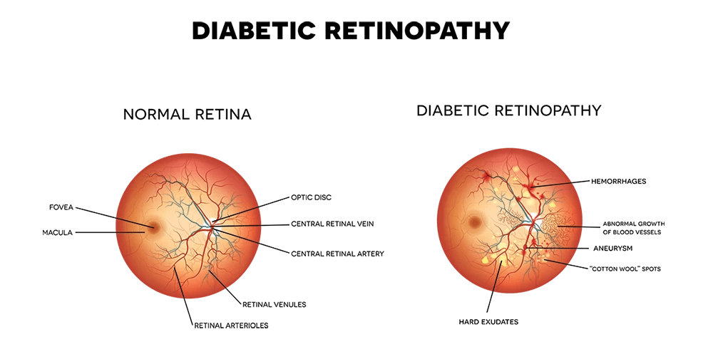 Diabetic Retinopathy Treatment Chicago and Chicagoland IL