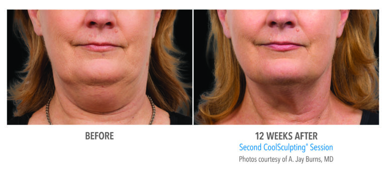 CoolSculpting Before & After Krauss Dermatology