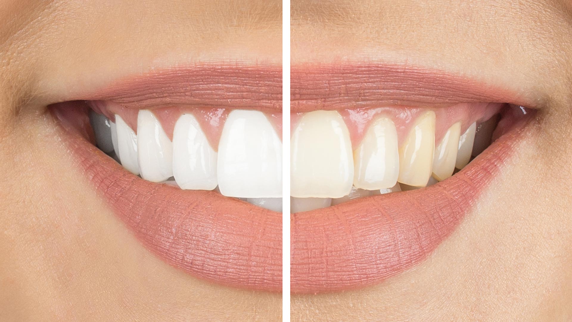 Bleaching Salzburg › Dres. Krnjic