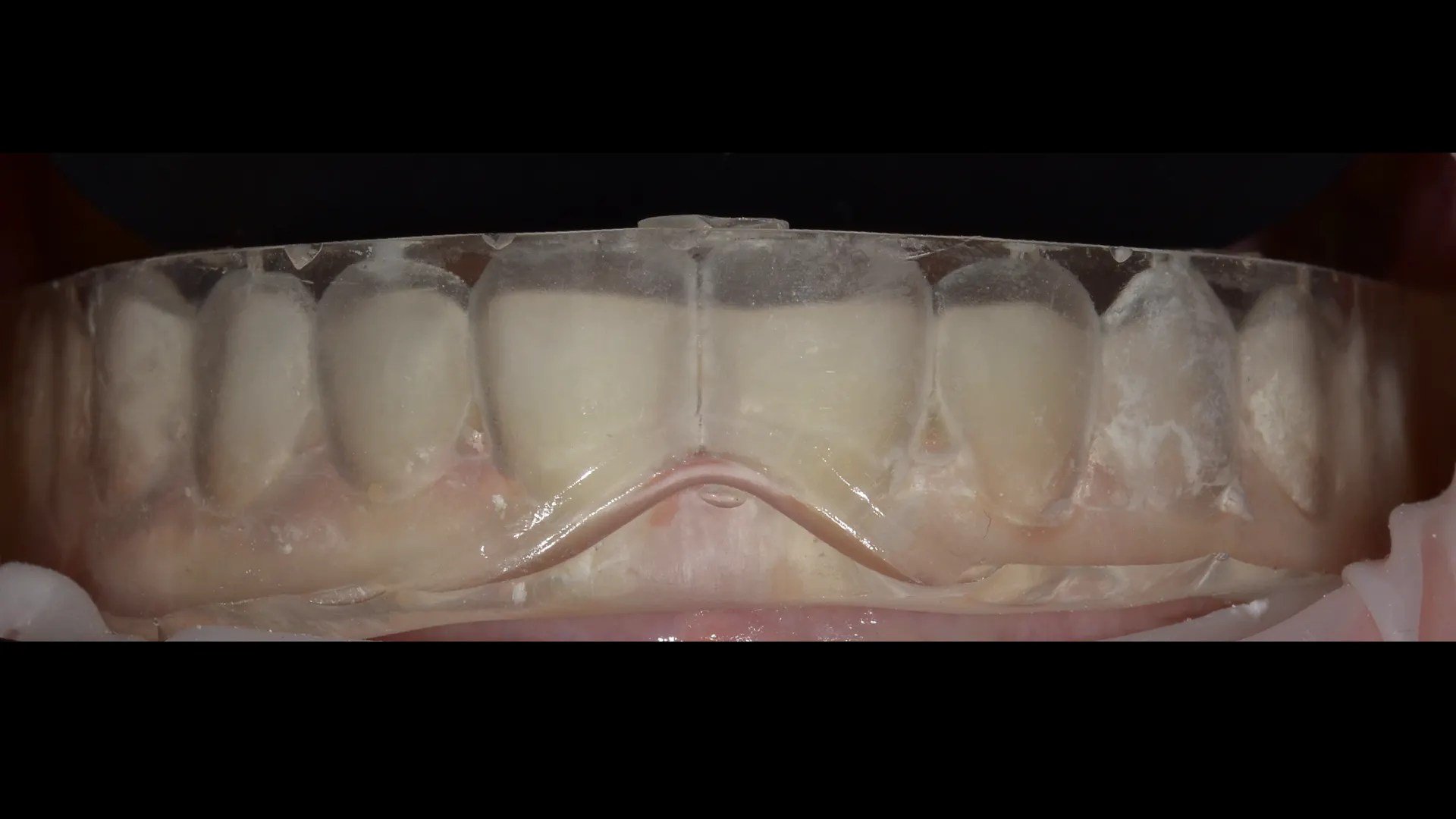Flowable Injection Technique, a flowable composite