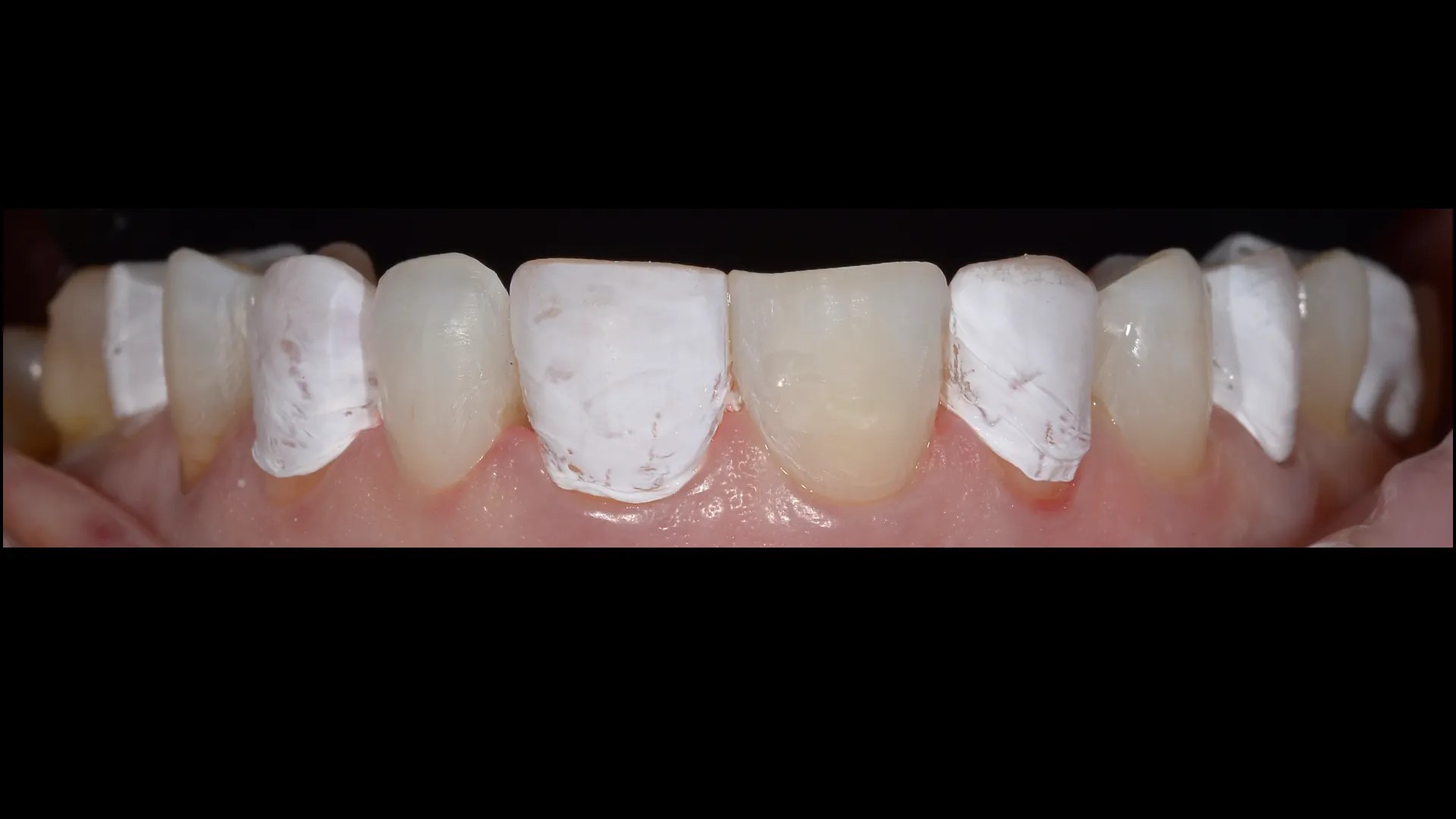 Flowable Injection Technique, a flowable composite