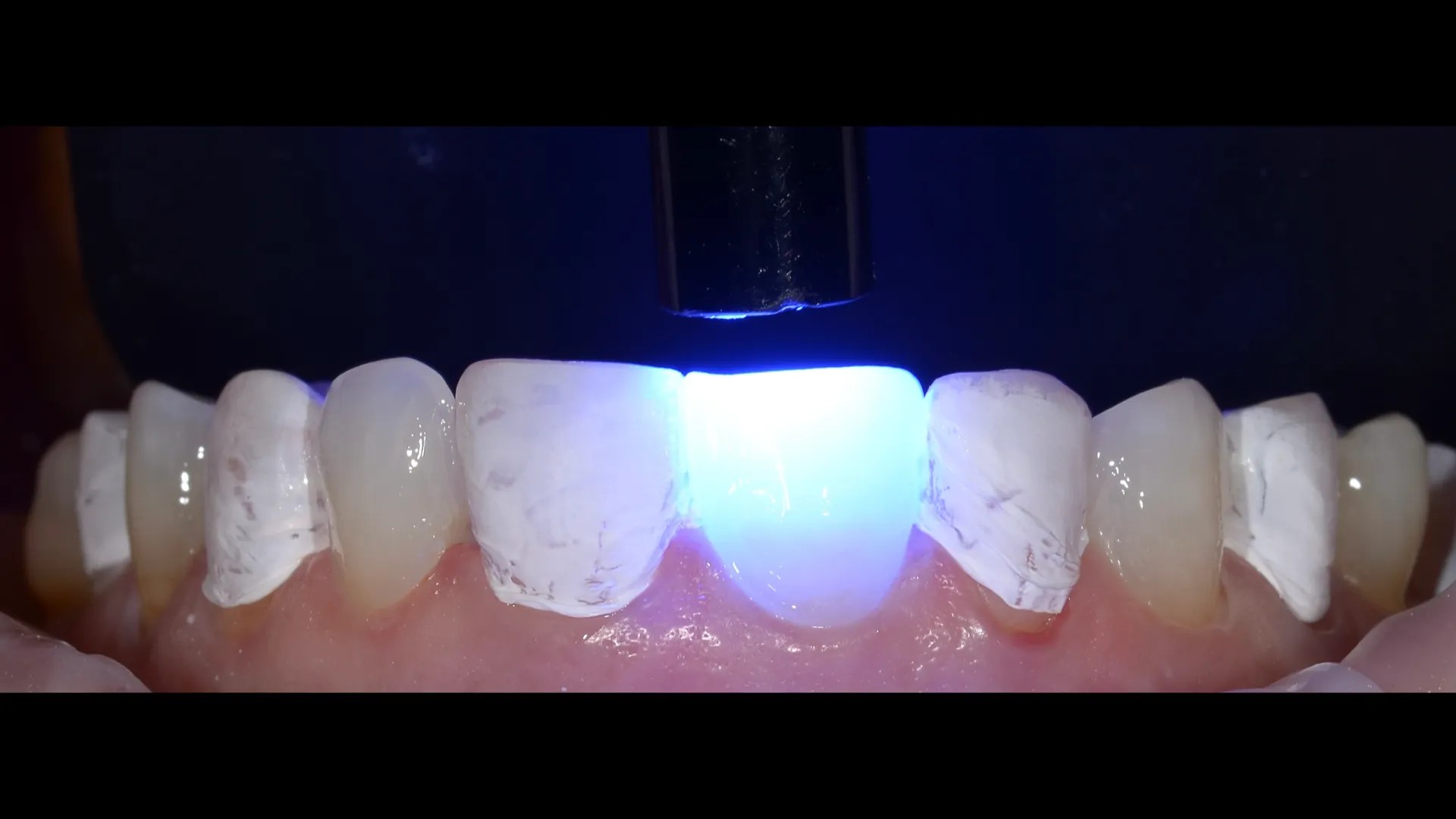 Flowable Injection Technique, a flowable composite