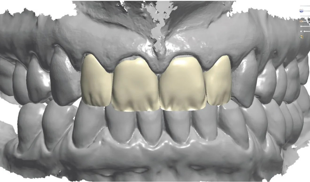 Clinical report by MDT Daniele Rondoni