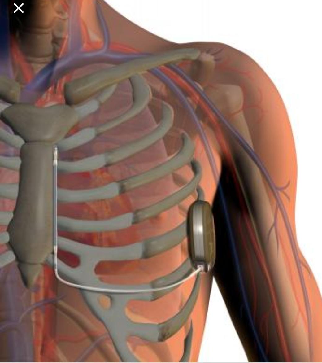 Automatic Implantable Cardioverter Defibrillators (AICD or ICD