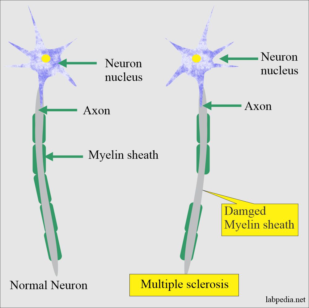 Multiple Sclerosis Neuron