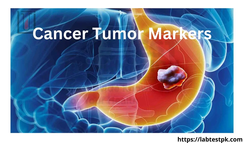 Cancer Tumor Markers, Types of Cancer Lab Test Information