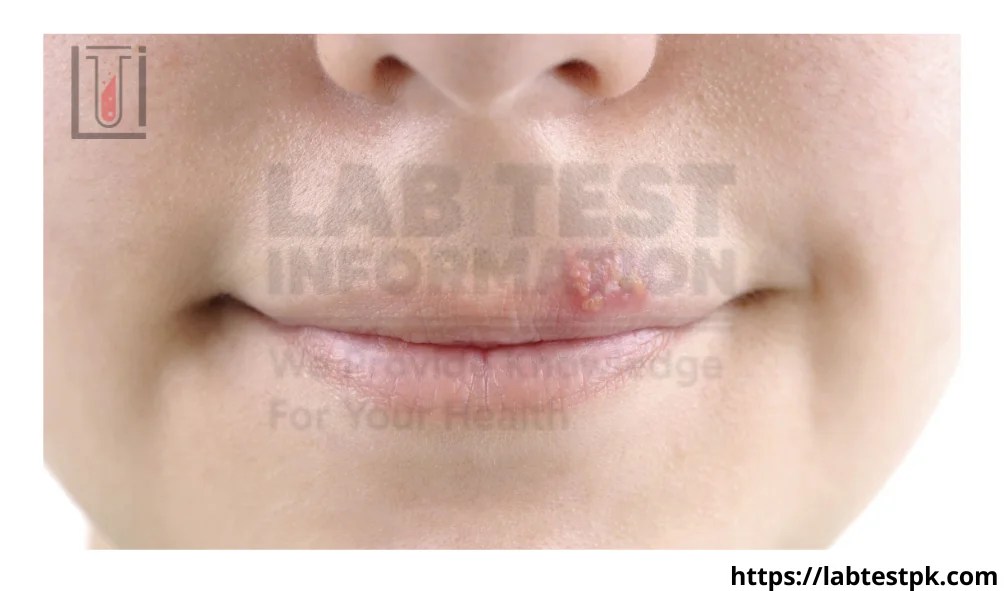 Cold sores treatment