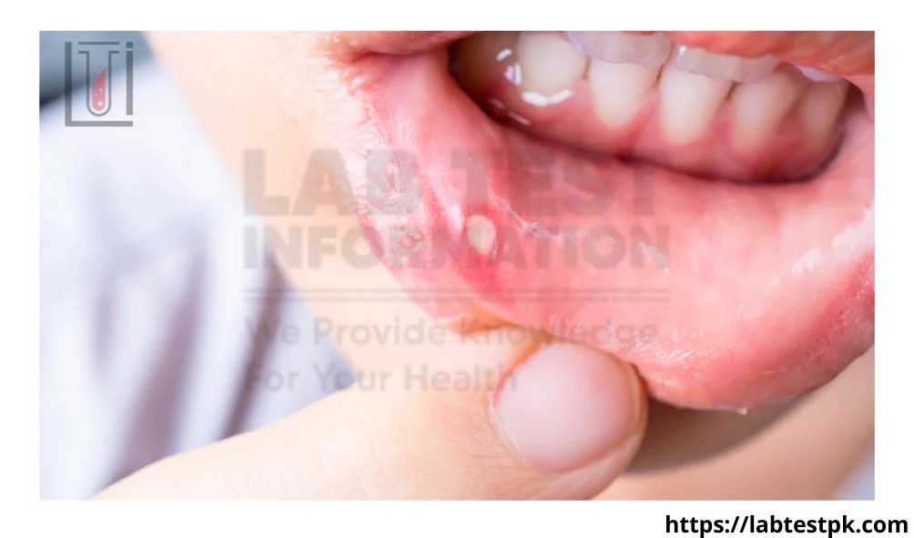 Canker Sores causes