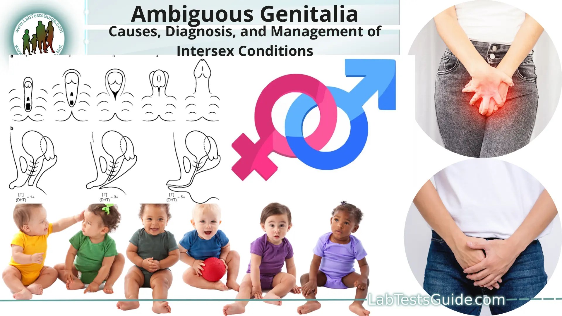 Ambiguous Genitalia Causes, Diagnosis, and Management of Intersex