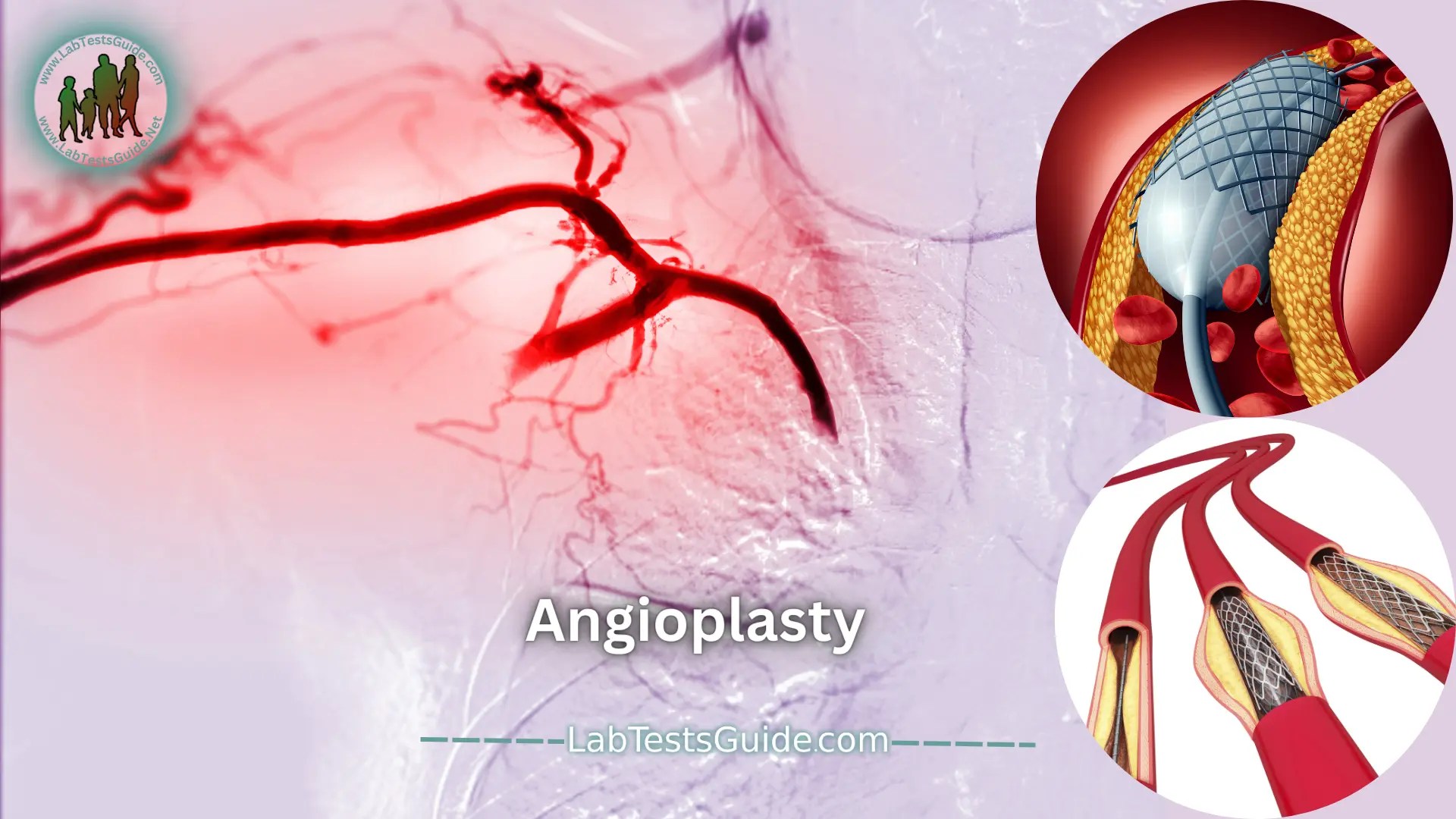 Angioplasty Procedure, Benefits, Risks, and Recovery