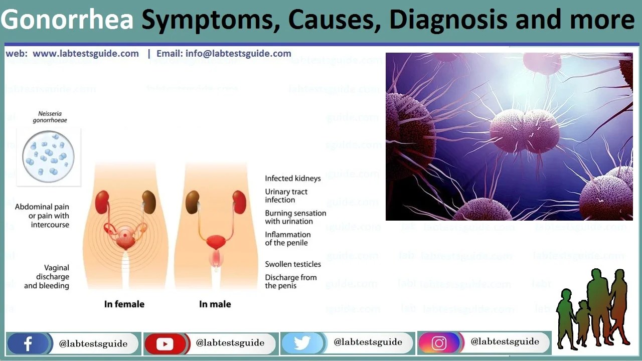 Gonorrhea Symptoms, Causes, Diagnosis And More - Lab Tests Guide