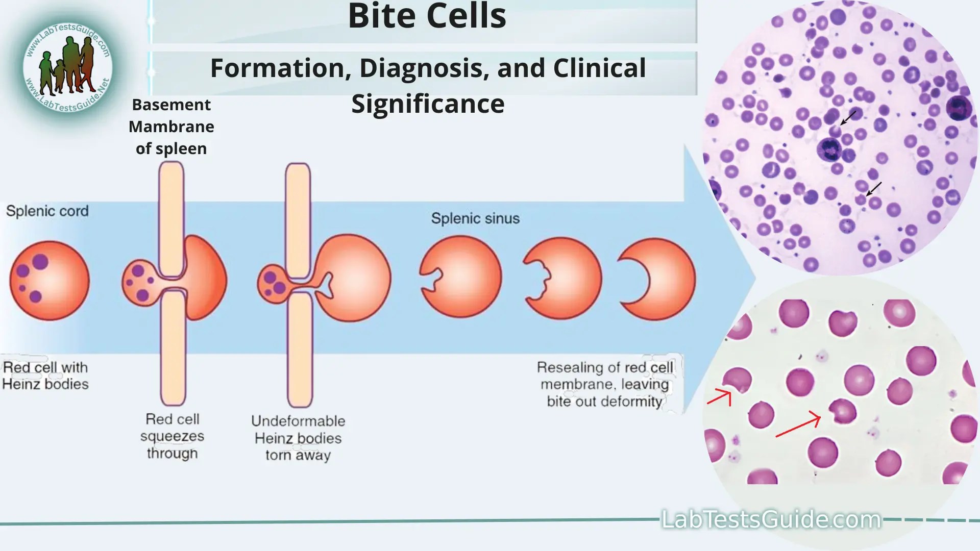 Bite Cells Formation, Diagnosis, and Clinical Significance