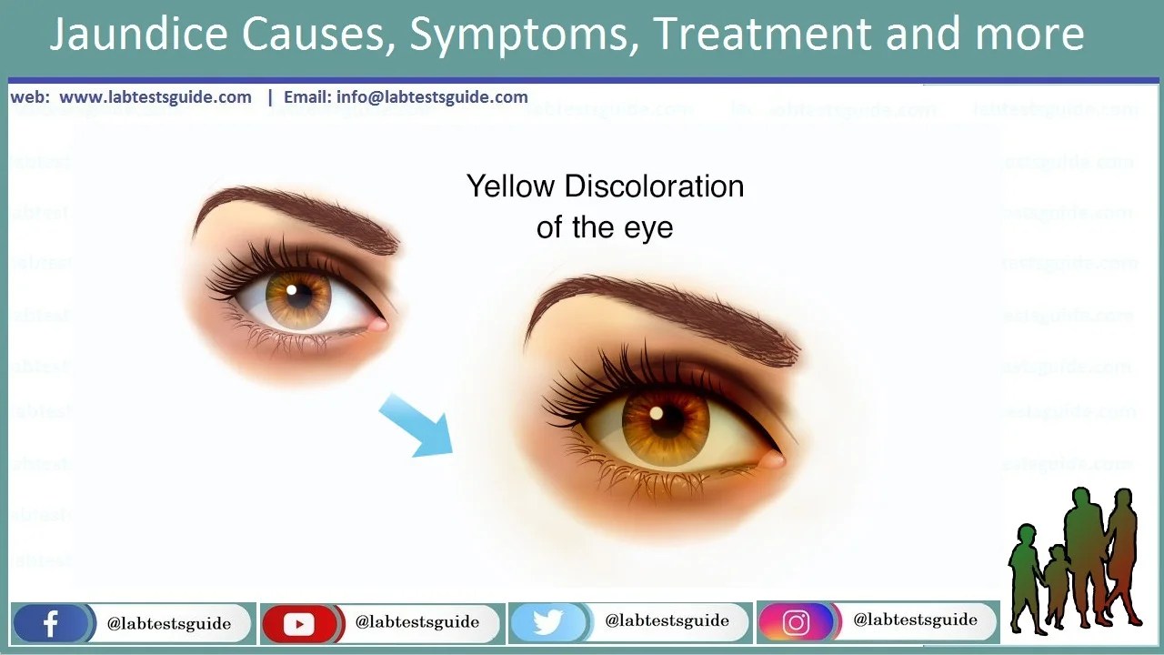 Jaundice Causes, Symptoms, Treatment and more Lab Tests Guide