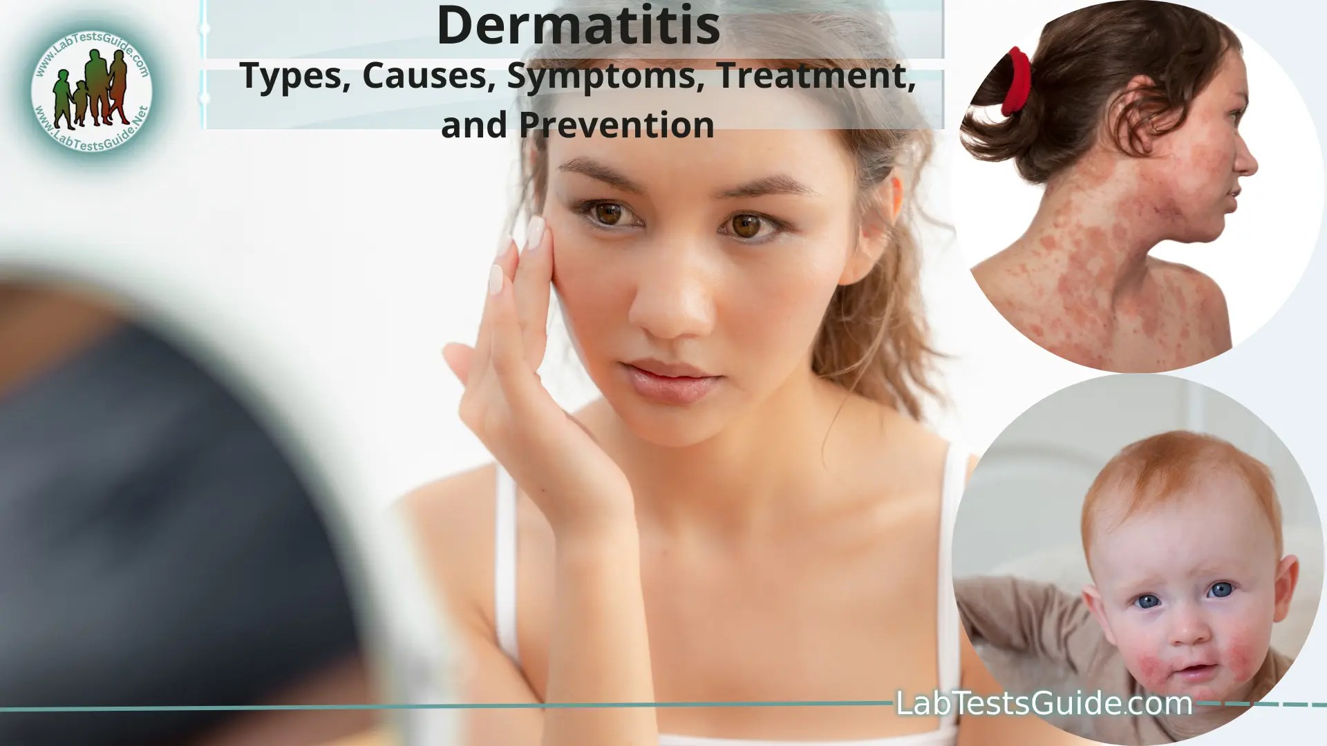 Dermatitis Types, Causes, Symptoms, Treatment, and Prevention