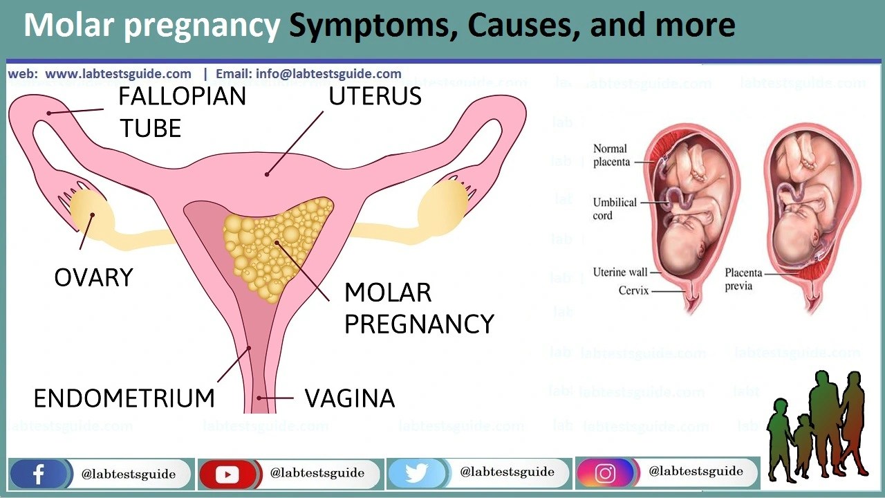 Understanding Molar Pregnancy Causes, Symptoms, and Treatment