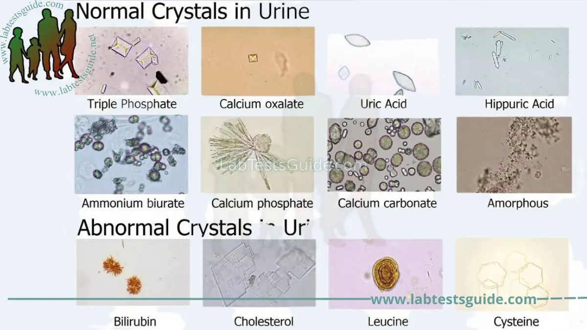 Crystals in Urine Causes, Symptoms, and Treatment A Comprehensive Guide
