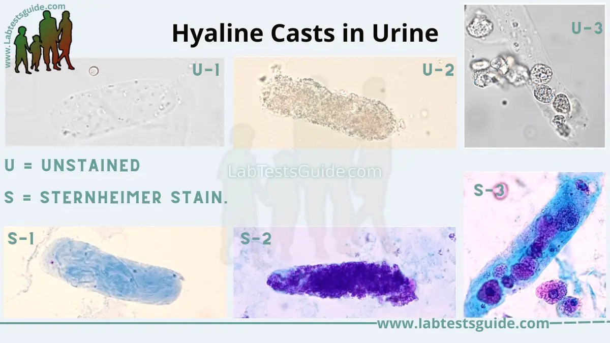 Hyaline Casts What Are They, Causes, Diagnosis, Treatment,, 60 OFF
