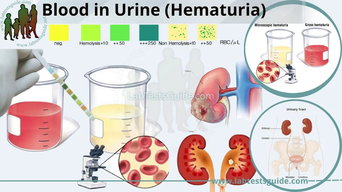 Hematuria Explained Lab Tests Guide