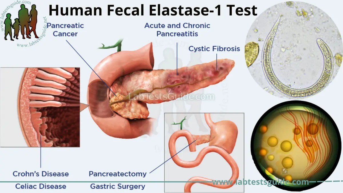 Human Fecal Elastase1 Test Purpose, Procedure, and Results