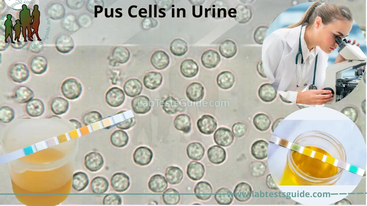 Pus Cells in Urine Lab Tests Guide