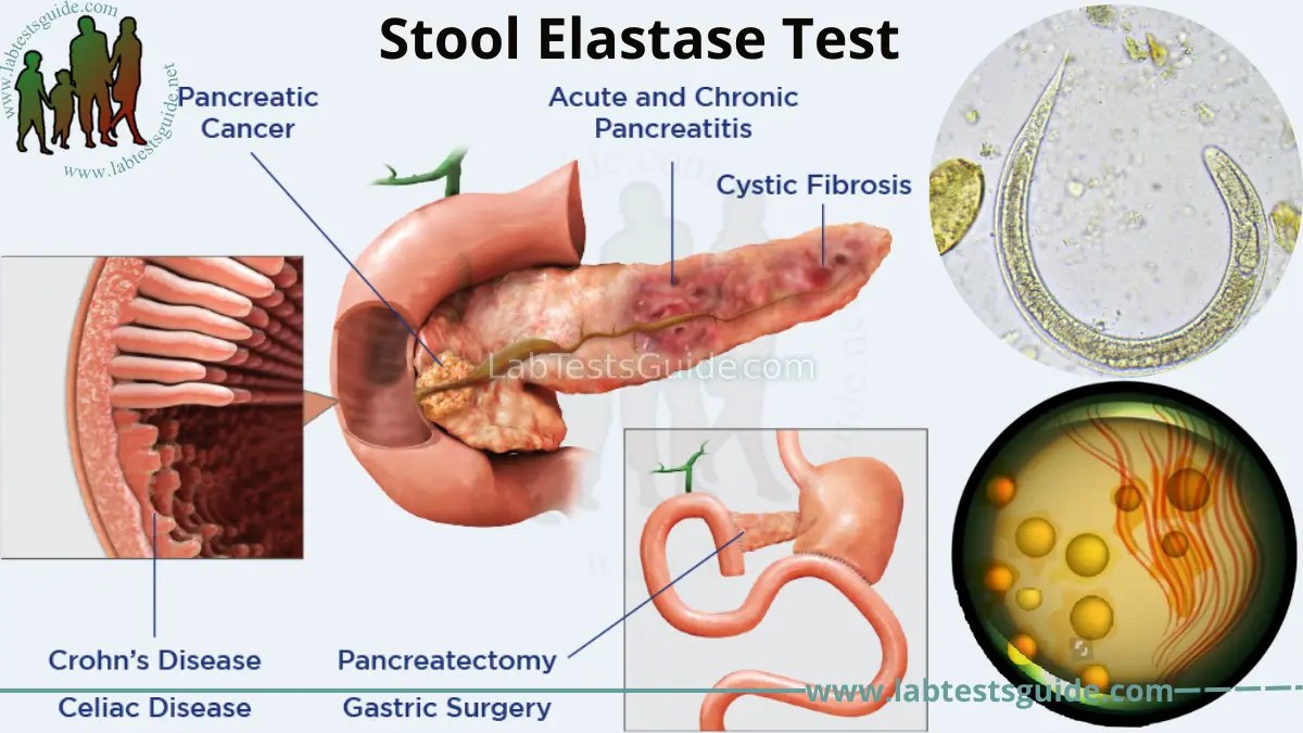 Stool Elastase Test Purpose, Procedure, and Results Everything You