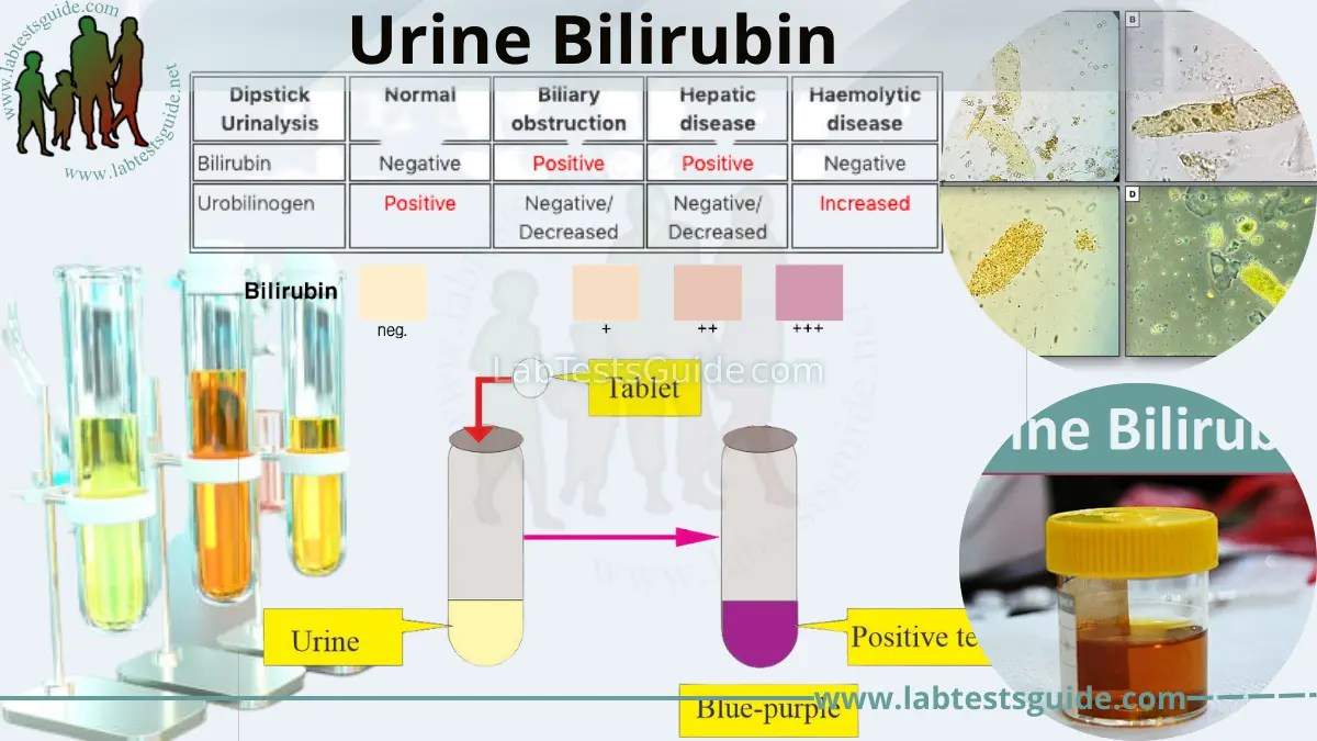 Urine Bilirubin Normal Range, Test Results, and Clinical Significance