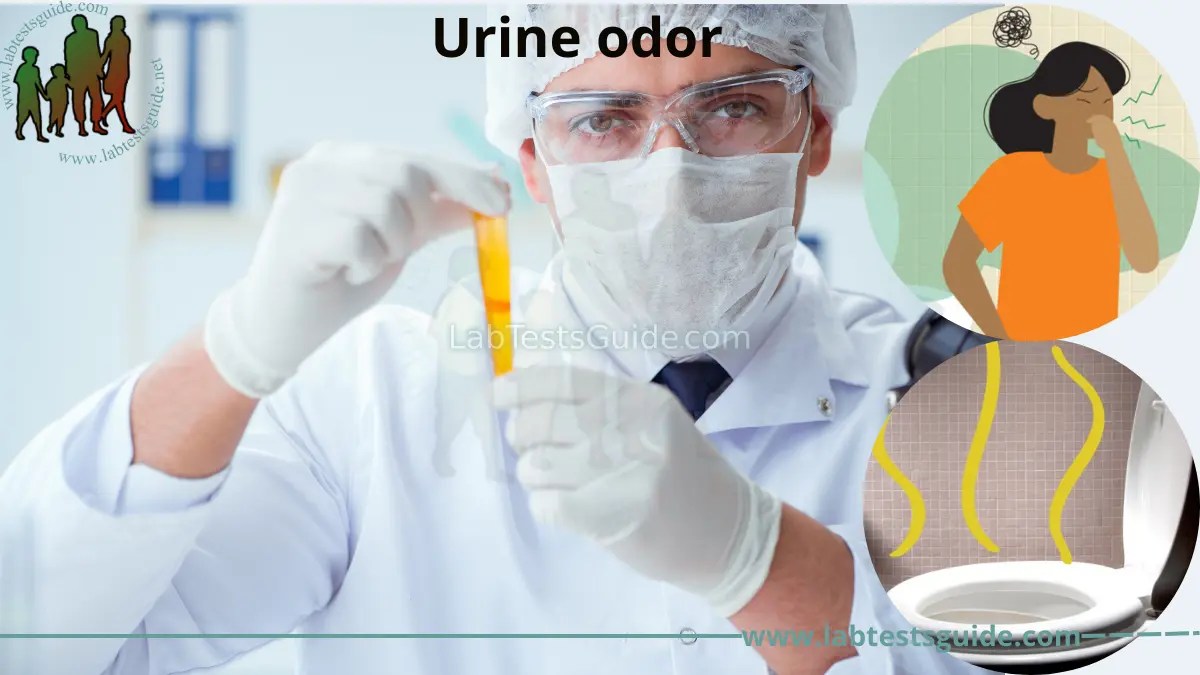Urine Odor Causes, Treatment, Preventions and more Lab Tests Guide