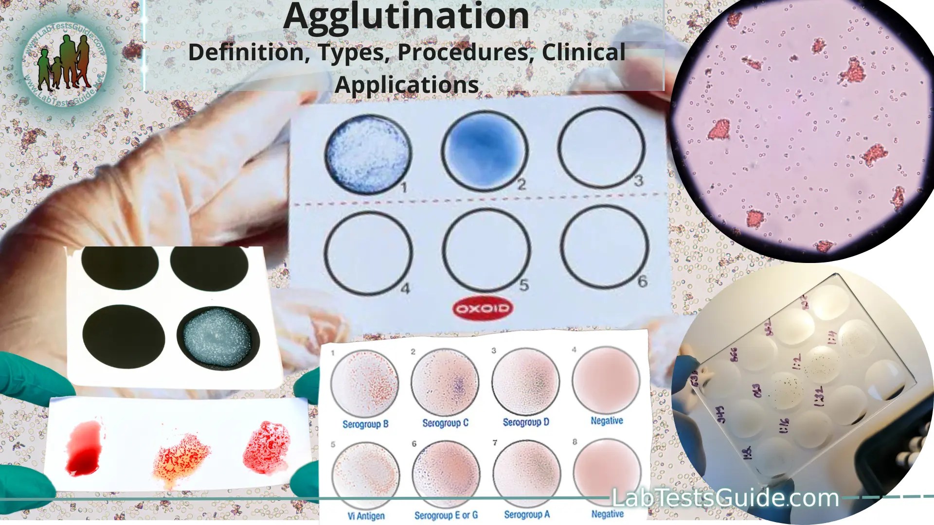 Agglutination Definition, Types, Procedures and Clinical Applications