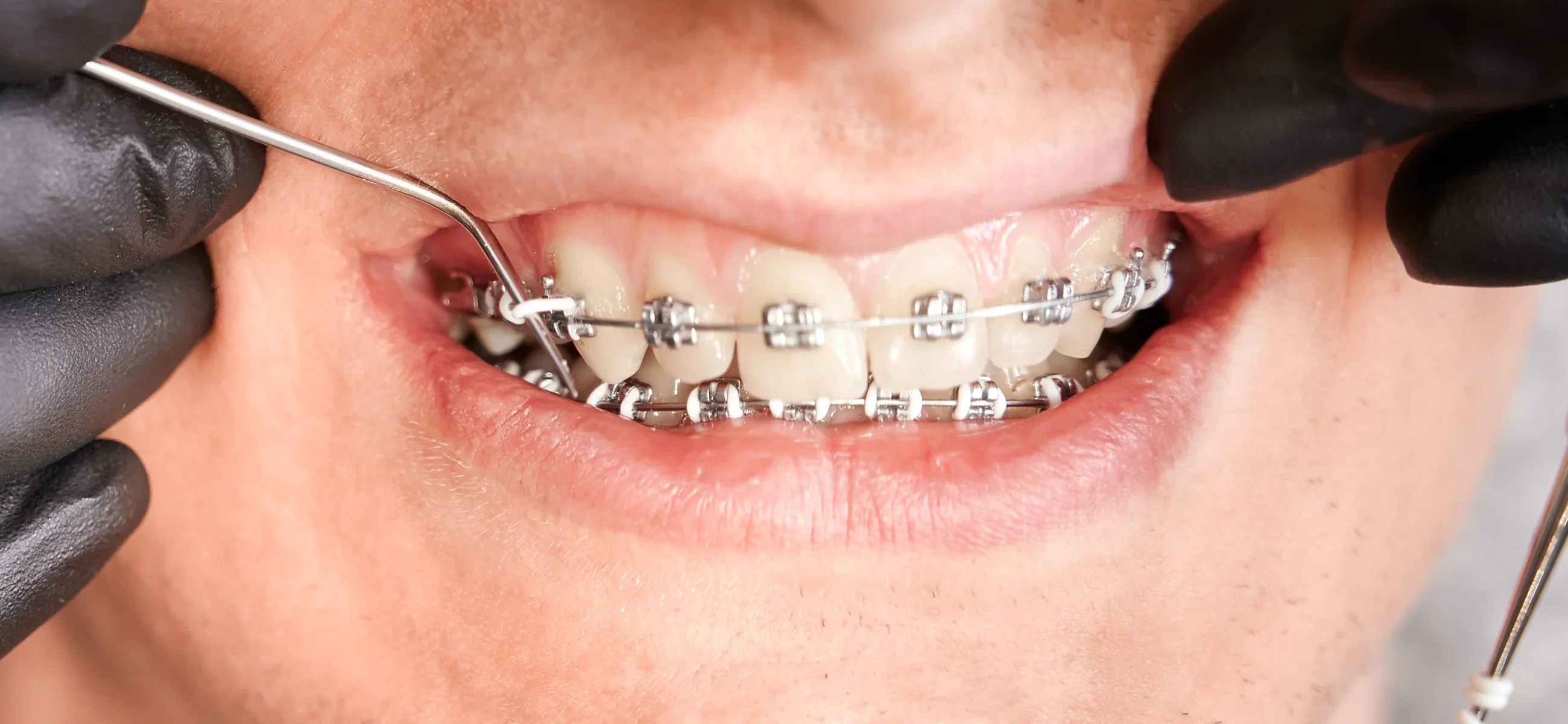 How much do braces cost? Laifen US