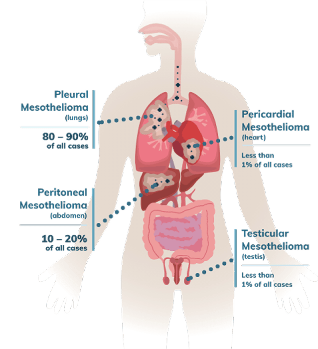 Mesothelioma Cancer The Lanier Law Firm