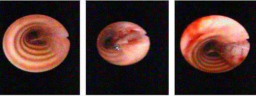 Bronchoscopy