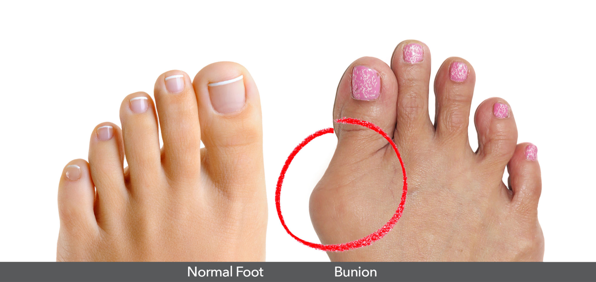 What is a Bunion? Hallux Valgus Treace Medical Concepts, Inc.