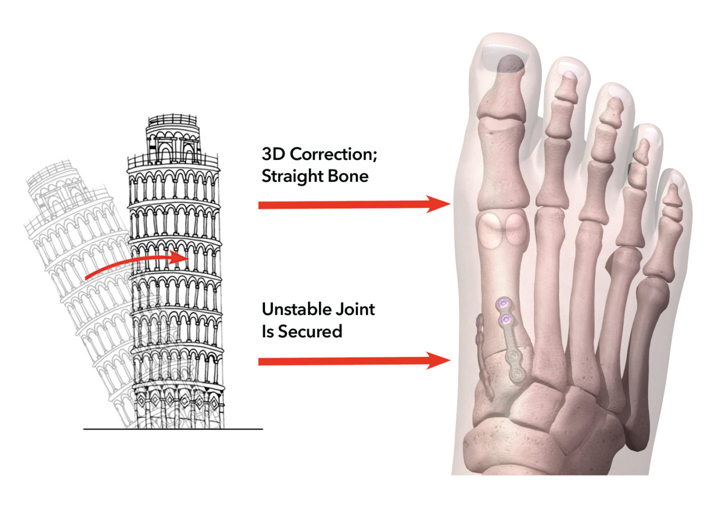 Lapiplasty® 3D Bunion Correction™ Treace Medical Concepts, Inc.