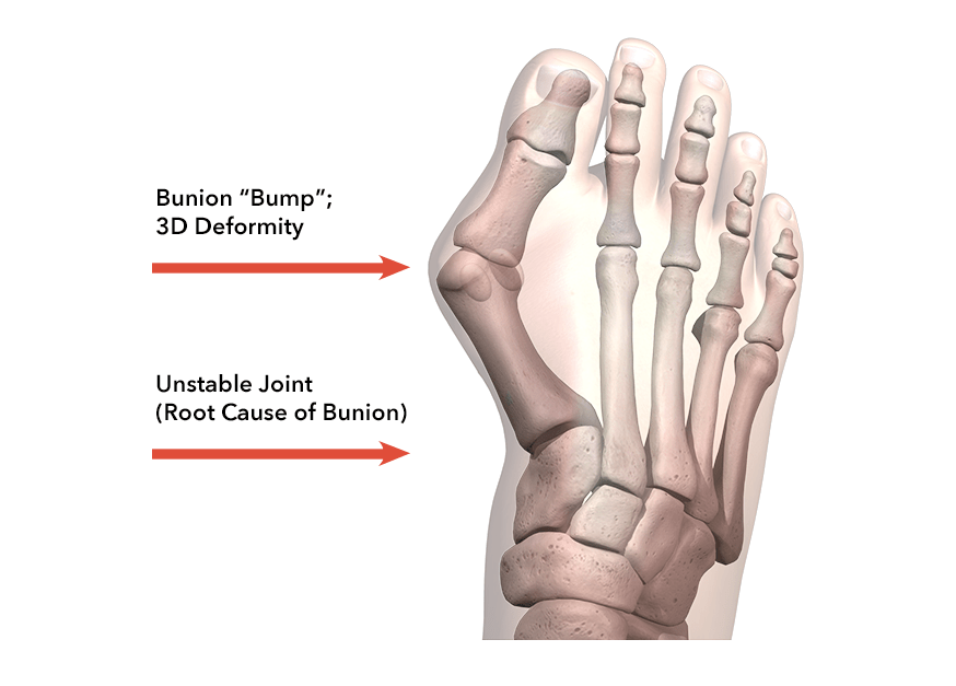 Lapiplasty® 3D Bunion Correction® Treace Medical Concepts, Inc.