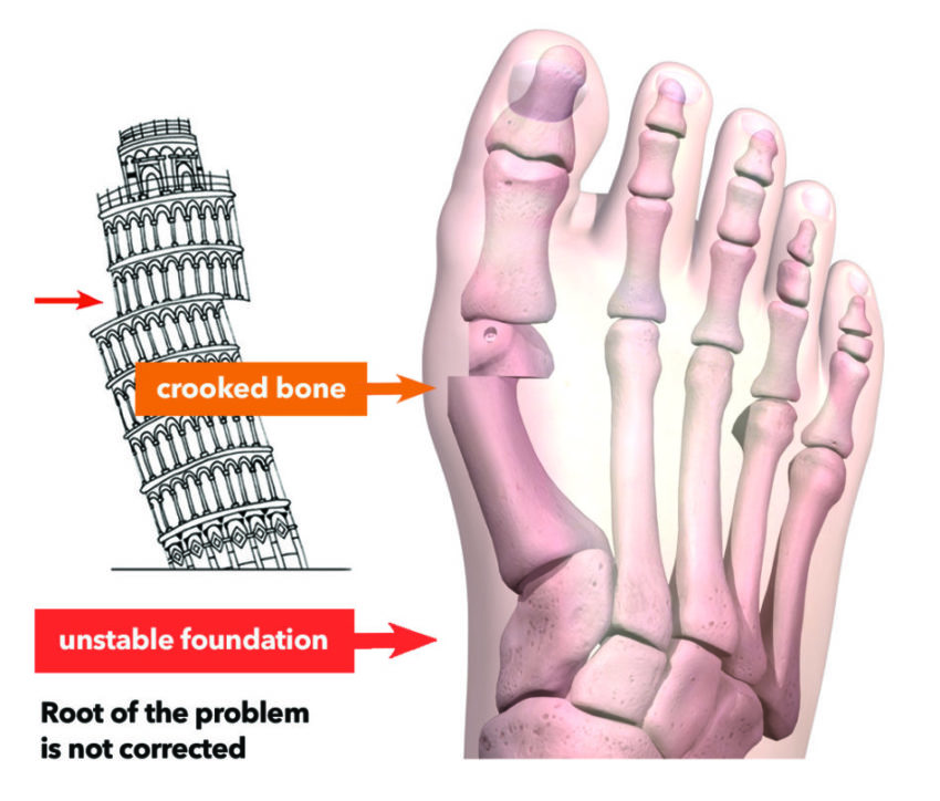 Lapiplasty® 3D Bunion Correction™ Outpatient Bunion Surgery