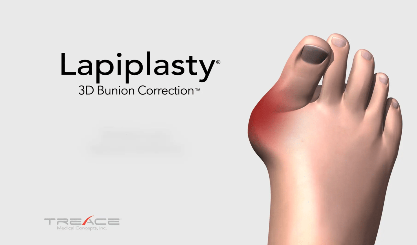 Lapiplasty® 3D Bunion Correction™ Outpatient Bunion Surgery