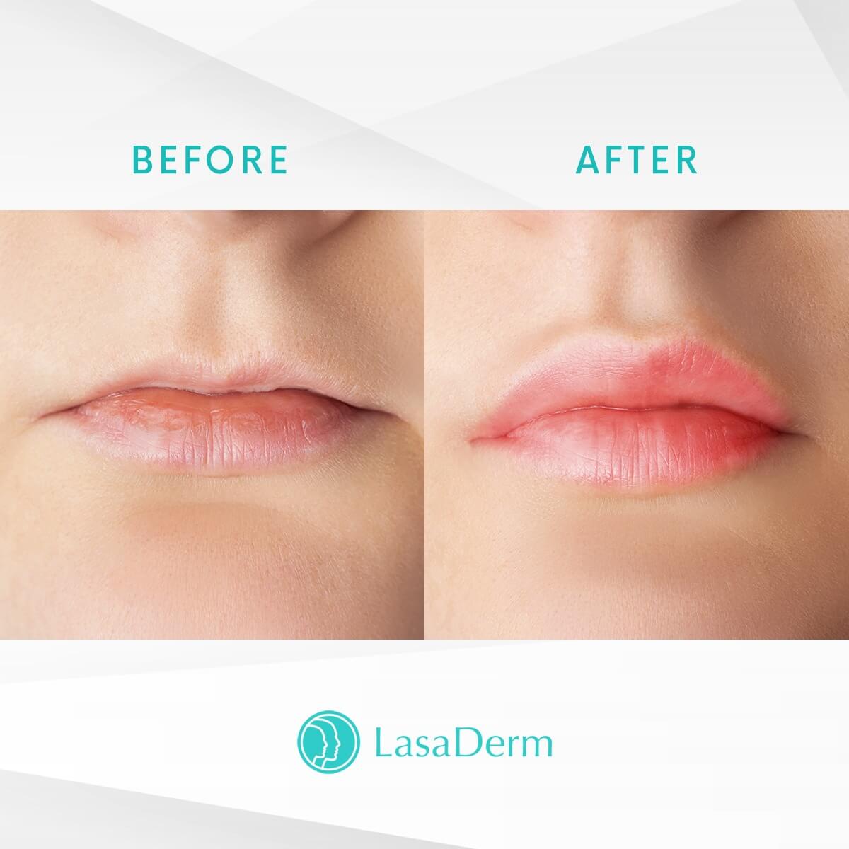 Teosyal Kiss Lip Filler Success Story LasaDerm