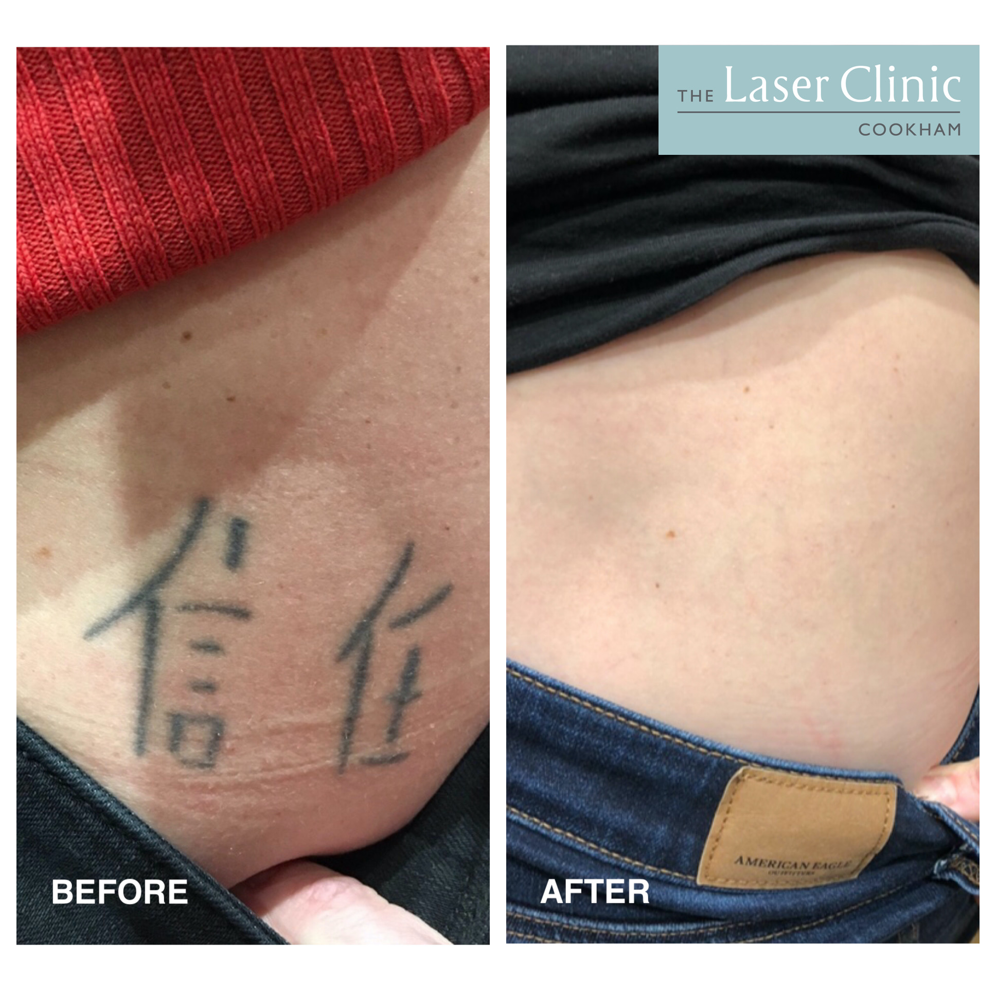Top 65+ tattoo removal reddit latest esthdonghoadian