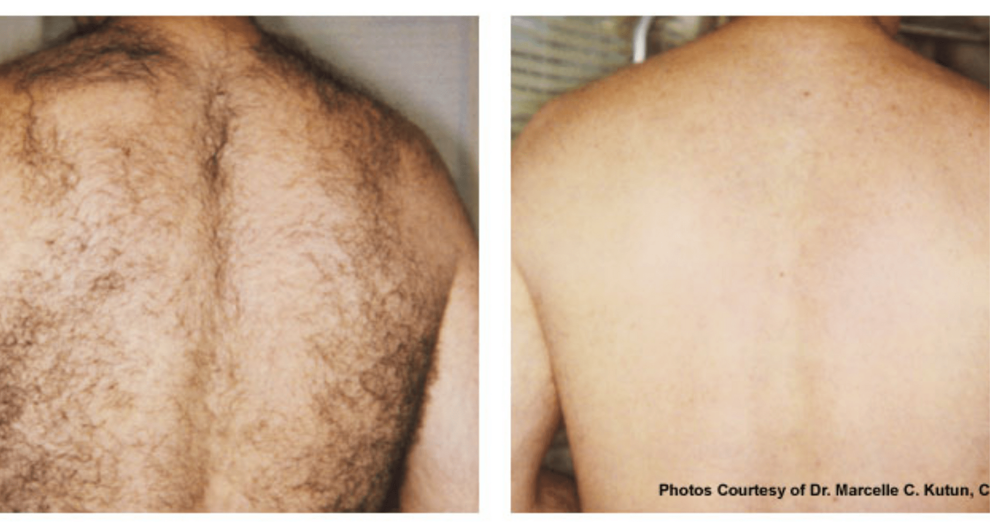 Laser Hair Removal Laser of Arlington