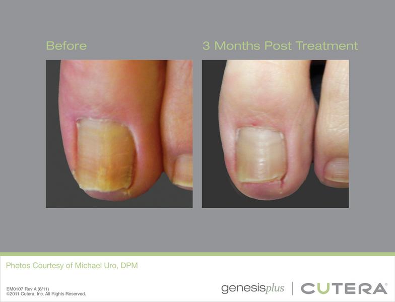 Laser Toenail Clinic Los Angeles, CA 90012