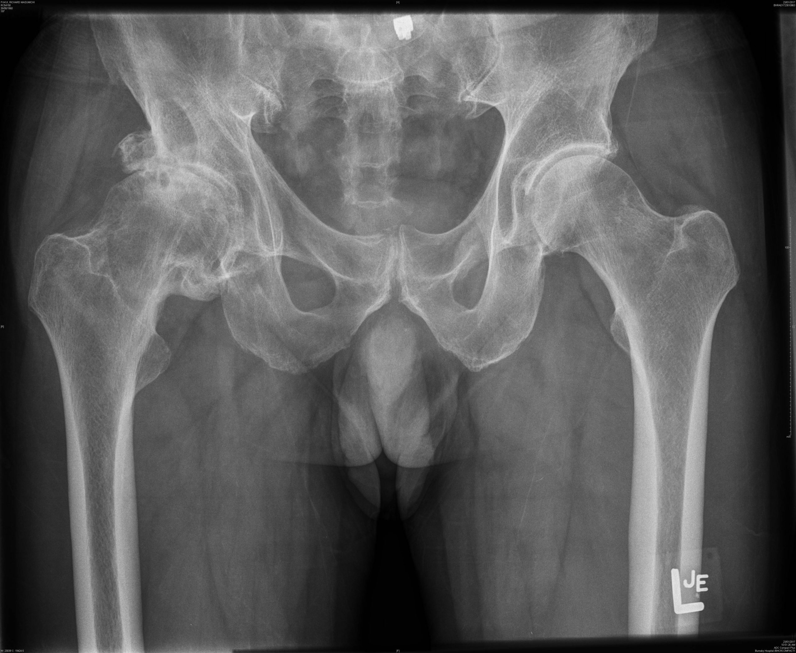 (VIDEOS INSIDE) Manual Therapy and Exercise for OA Patients