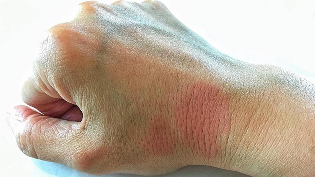 Experto salami Gimnasta señales de lupus relajarse Whitney cómo utilizar