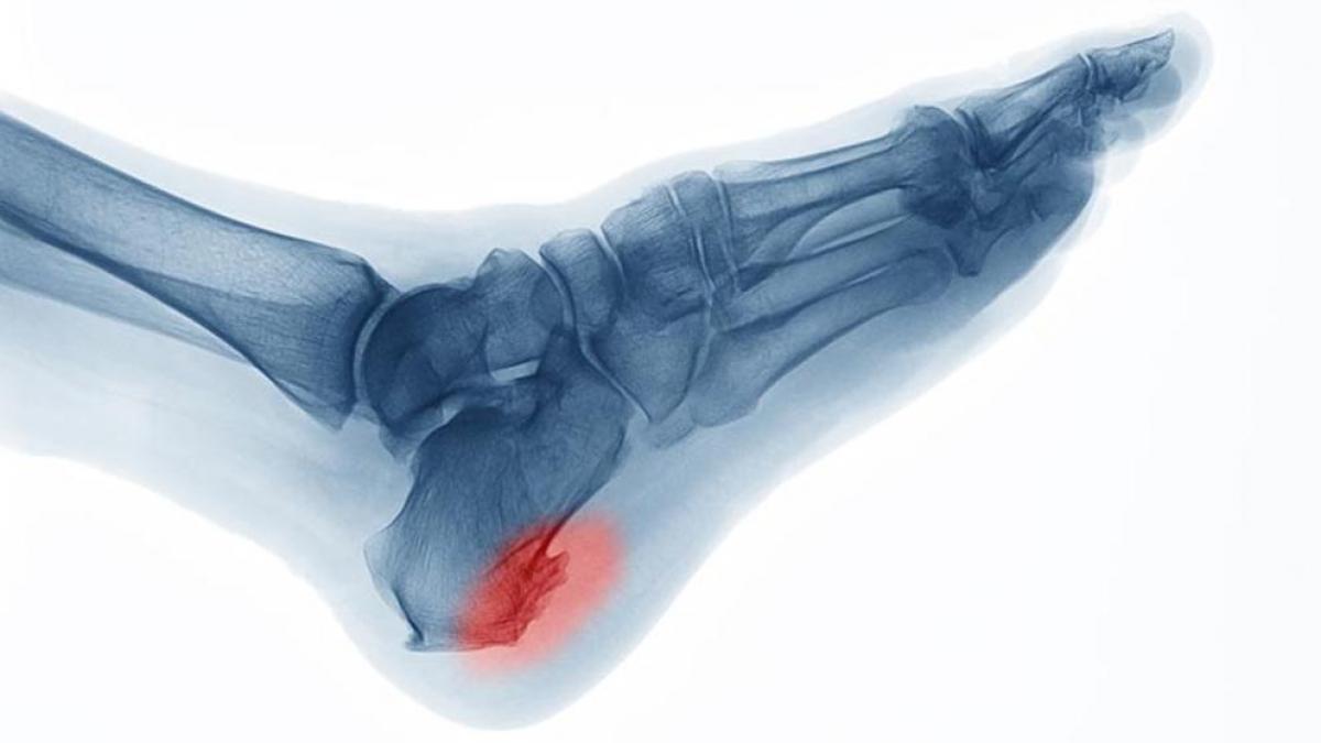 ¿Qué es el espolón óseo? Síntomas, causas y cómo tratar la enfermedad