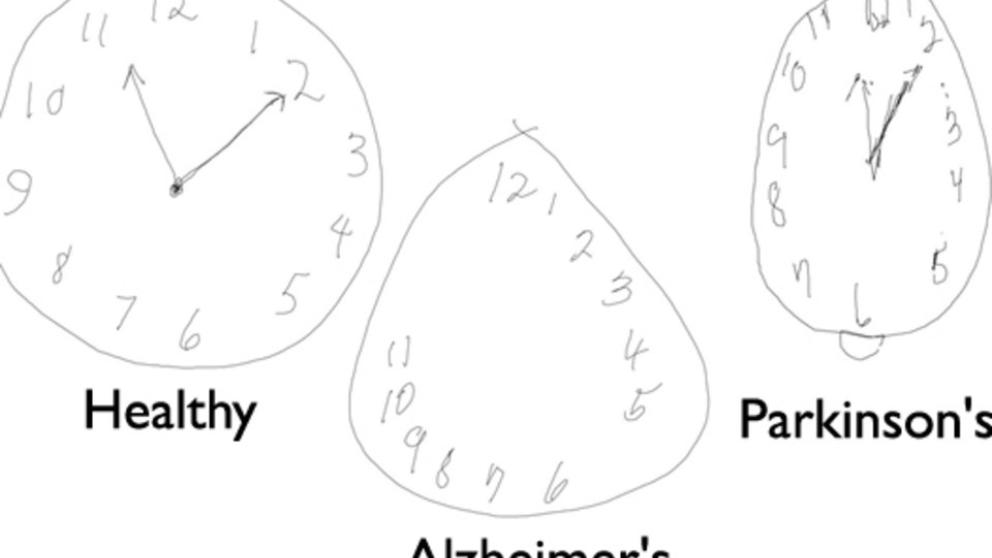 Un test del reloj mejorado para detectar Alzheimer y Parkinson